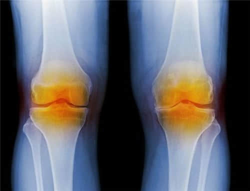 膝盖经常弹响,是膝盖出问题了吗?