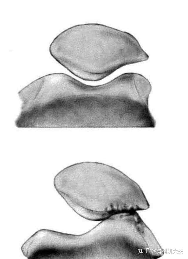 爬楼梯膝盖就疼，这究竟是怎么回事？