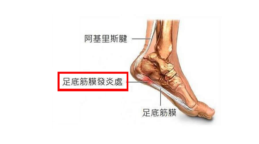 哪些人或者哪些习惯 容易患足底筋膜炎？