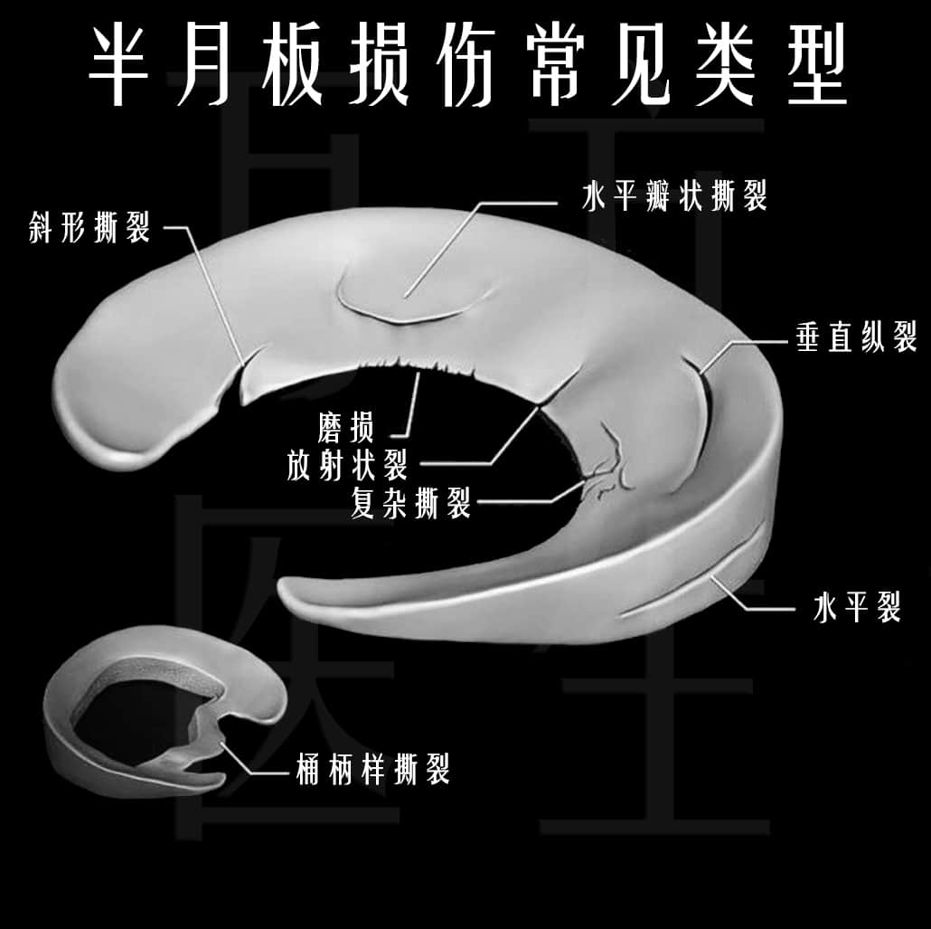 上下楼梯膝盖疼痛是什么原因