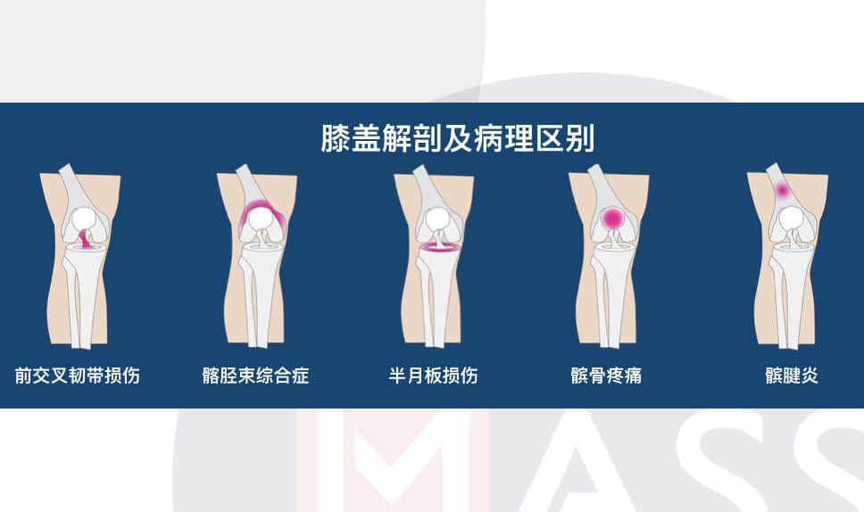 如何分辨半月板损伤还是韧带损伤?