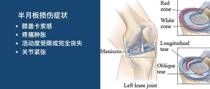 如何分辨半月板损伤还是韧带损伤?