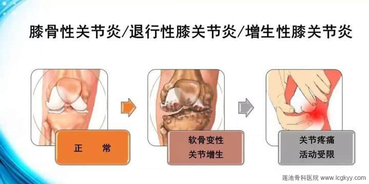 膝骨性关节炎，“保膝”“换膝”如何选？